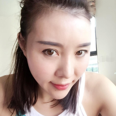 深圳光明医院全脸自体脂肪案例分享!
