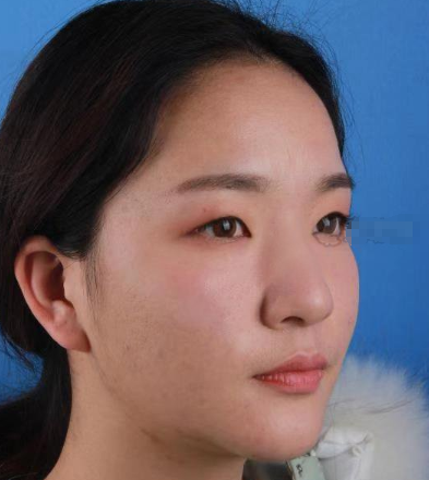 南京维多利亚美容医生李志生眼部多项手术案例