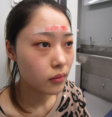 成都素美医疗美容全切双眼皮怎么样呢?