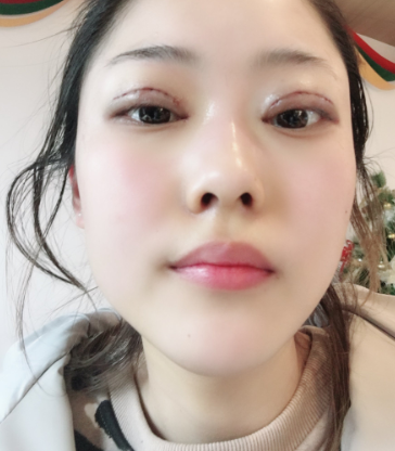 成都素美医疗美容全切双眼皮怎么样呢?