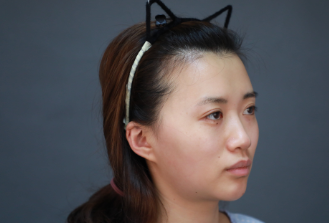 南京美莱整形隆鼻怎么样?隆鼻案例