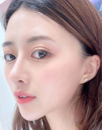 南京美莱整形隆鼻怎么样?隆鼻案例
