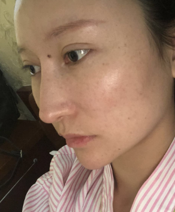 上海愉悦美联臣医美医院下颌角整形怎么样?