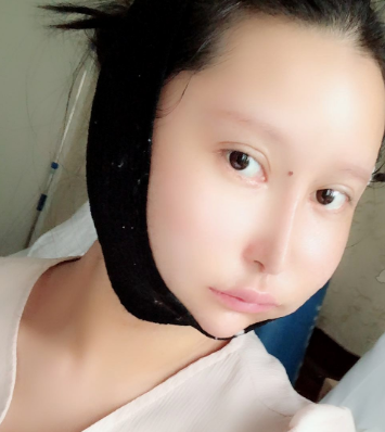 上海愉悦美联臣医美医院下颌角整形怎么样?