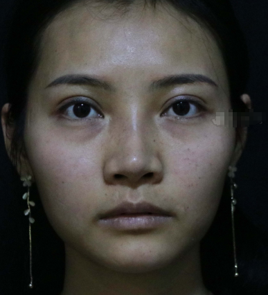 金陵嘉怡美医疗美容医院自体脂肪丰额头果怎