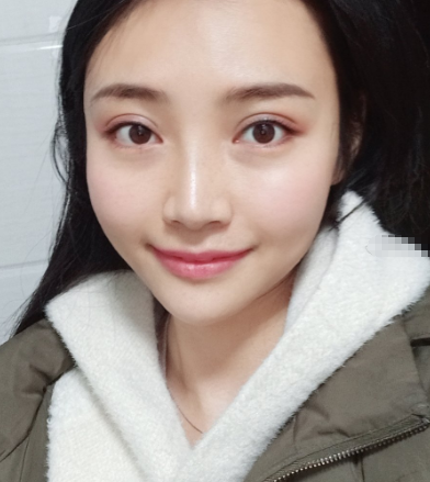 金陵嘉怡美医疗美容医院自体脂肪丰额头果怎