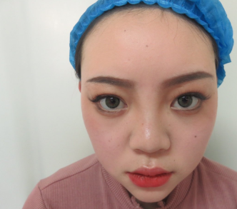 郑州茉莉亚医疗美容隆鼻果怎么样？