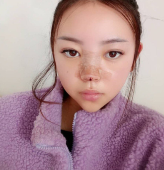 郑州茉莉亚医疗美容隆鼻果怎么样？