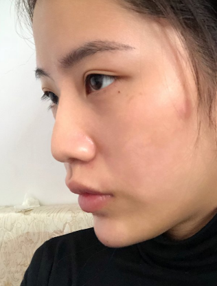 贵阳美贝尔硅胶隆鼻怎么样?隆鼻案例