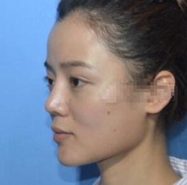 宁波美莱整形医生孙明磊鼻部手术案例分享！