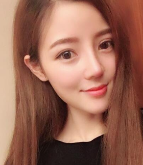 宁波美莱整形医生孙明磊鼻部手术案例分享！
