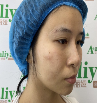 杭州艾丽娅医疗美容下眼下至术案例分享!