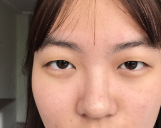 温州伯思立医生邹仙娥眼部多项案例分享!