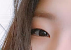 泉州美莱华美医生宋凡伟眼部多项案例分享!