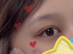 泉州美莱华美医生宋凡伟眼部多项案例分享!