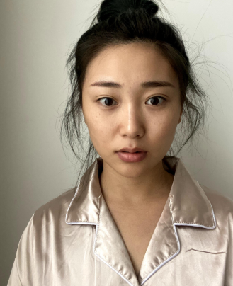 泉州美莱华美医生杨和强鼻部多项案例分享!