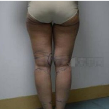 成都中科美医生蒲浩大腿吸脂术后2月案例附果