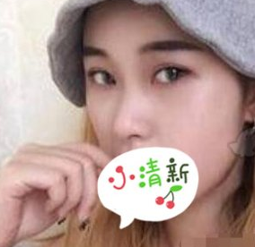 广州美莱医学美容鼻部手术术案例分享!