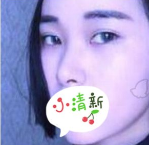 广州美莱医学美容鼻部手术术案例分享!