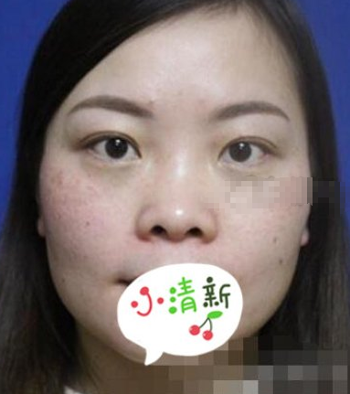 广州南方医院隆鼻术后一个月真实感受分享!