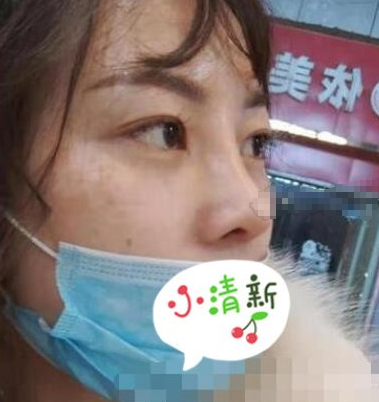 广州南方医院隆鼻术后一个月真实感受分享!