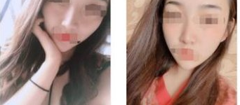 昆明艺星医美激光祛斑术后60天果分享！