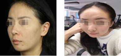 昆明艺星医美光子嫩肤术后感受附果图!