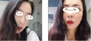 昆明艺星医美光子嫩肤术后感受附果图!