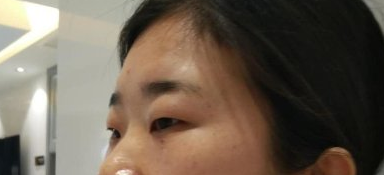荆州华美医疗整形门诊部切开双眼皮案例!