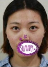 青岛华韩医美医生武伟亮太阳穴填充案例分享!