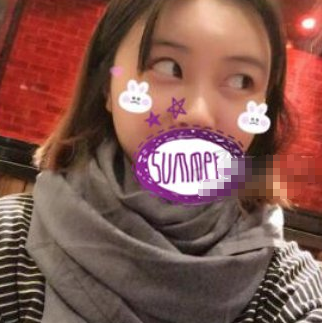 青岛华韩医美医生武伟亮太阳穴填充案例分享!