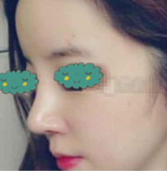 湖北十堰安琪儿医美医生马永奎鼻部手术案例分享