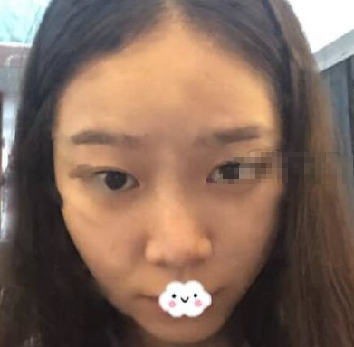 重庆铜雀台医美医生伍森林鼻部手术案例分享！