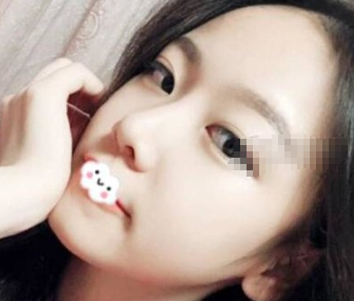 重庆铜雀台医美医生伍森林鼻部手术案例分享！