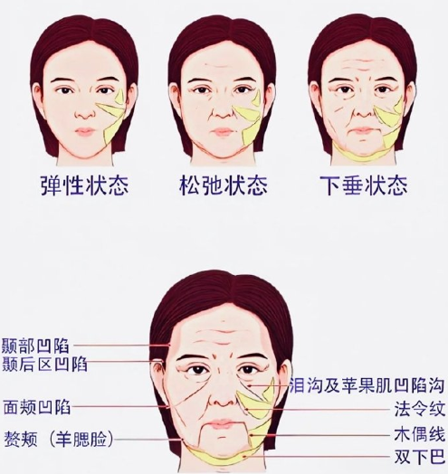 小切口拉皮除皱果怎么样？
