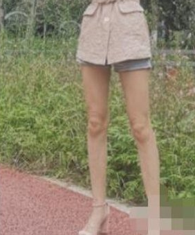 邯郸市中心医院医学美容科大腿吸脂术后分享!