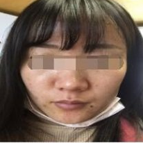 南京华美美容医院微针祛痘坑案例分享!
