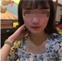 南京华美美容医院微针祛痘坑案例分享!