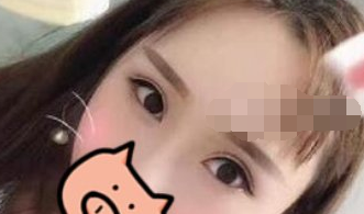 长沙雅美医学美容双眼皮案例分享!