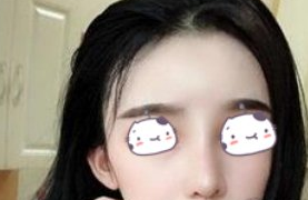 连云港徐杨医美假体隆鼻术后2月果分享！