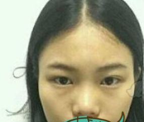 广州嘉悦医美医生胡葵葵鼻部手术术后60天分享！