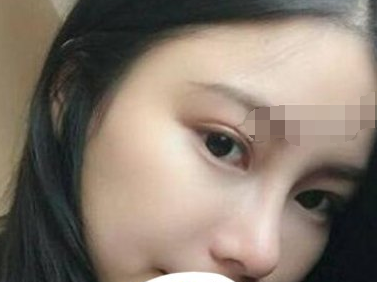广州嘉悦医美医生胡葵葵鼻部手术术后60天分享！