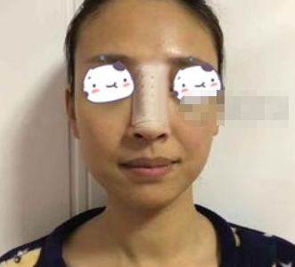 重庆联合丽格医美鼻部手术手术案例分享!