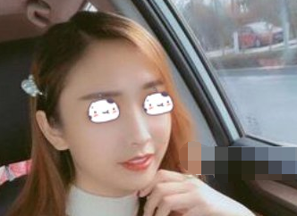 重庆联合丽格医美鼻部手术手术案例分享!