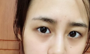 天津维美医疗美容切开双眼皮案例分享!