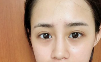 天津维美医疗美容切开双眼皮案例分享!