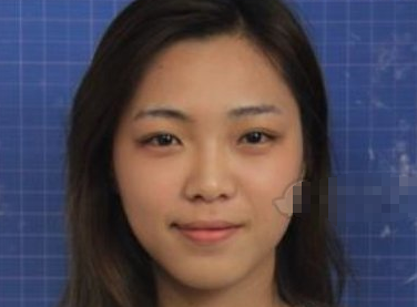 脸博士整形美容隆鼻术后感受及恢复果分享!