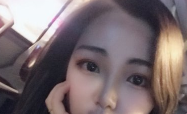 脸博士整形美容隆鼻术后感受及恢复果分享!