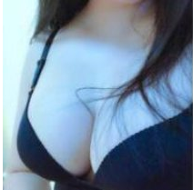 福州爱美尔整形美容假体隆胸案例分享!