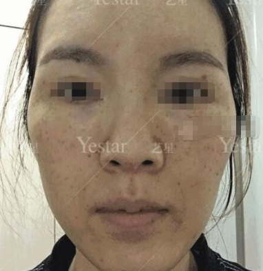 济南艺星医美超激光美肤祛斑案例分享!